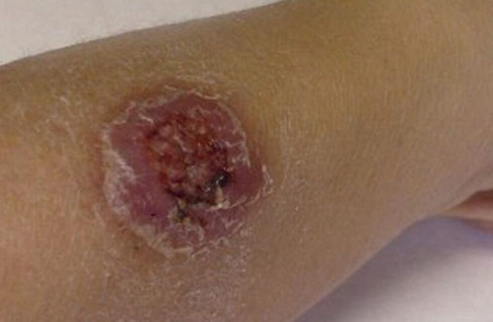 Confirman casos de leishmaniasis