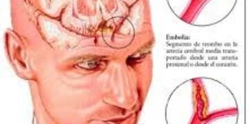 Imagen de accidentes cerebrovasculares\u002E (WEB)