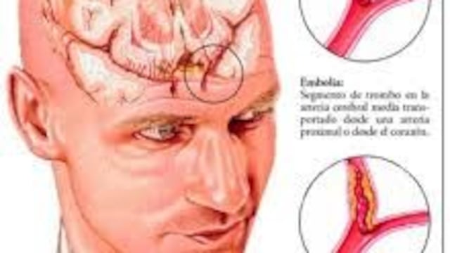 Imagen de accidentes cerebrovasculares\u002E (WEB)