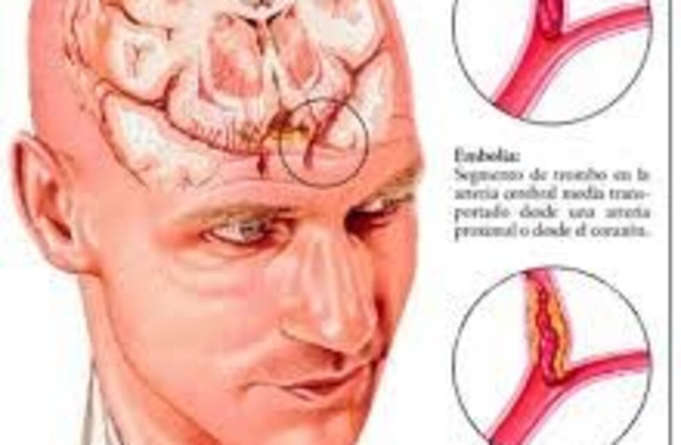 Misiones registra 3.500 ACV por año y alarma el índice nacional