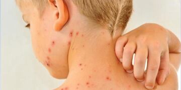 Alerta por sarampión: las respuestas a las preguntas más frecuentes