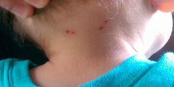 Rickettsia en niños\u002E (Web)