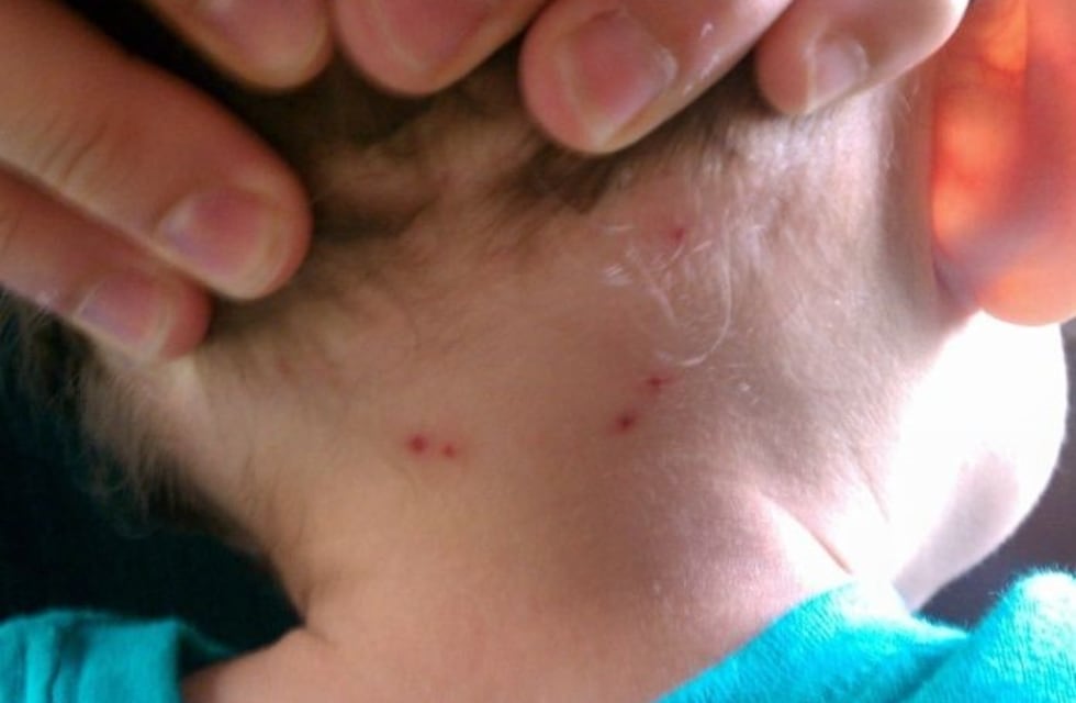 Picadura de garrapata mortal: un bebe dio positivo en Rickettsia