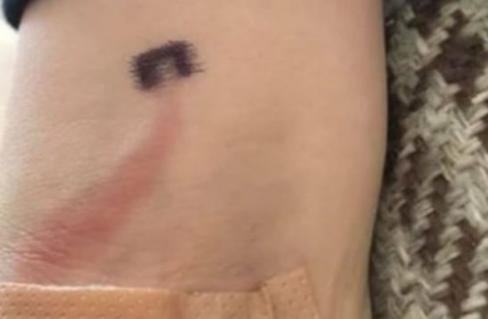 Descubrió una extraña marca roja en el brazo de su hijo y sin saberlo le salvó la vida