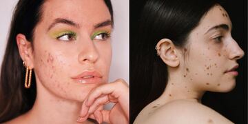 Todo lo que tenés que saber sobre el Skin Positive: el movimiento que promueve la aceptación y el cuidado de pieles.