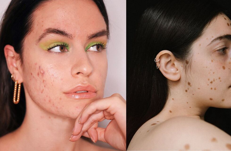 De qué trata el Skin Positive, el movimiento que promueve la aceptación y el cuidado de la piel