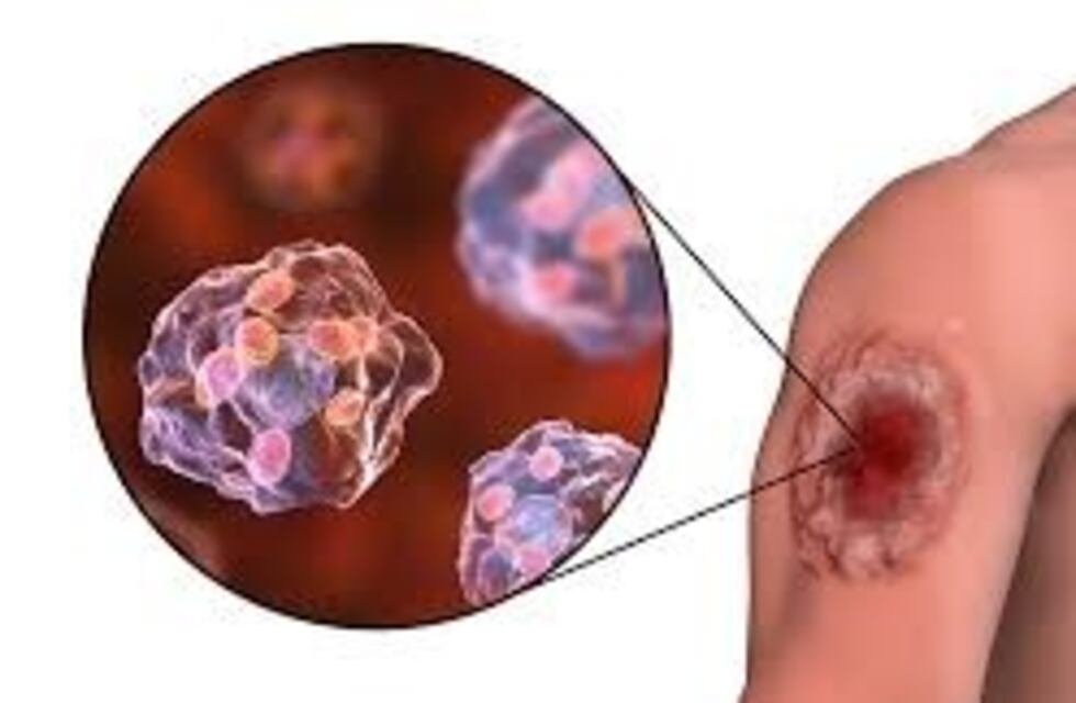 Concordia: jornada de capacitación sobre Leishmaniasis Visceral