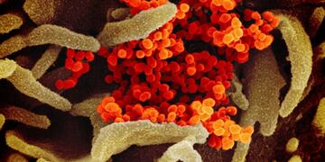This image provided by The National Institute of Allergy and Infectious Diseases (NIAID)\u002E This scanning electron microscope image shows SARS-CoV-2 (orange)—also known as 2019-nCoV, the virus that causes COVID-19—isolated from a patient in the U\u002ES\u002E, emerging from the surface of cells (green) cultured in the lab\u002E (NIAID-RML via AP)