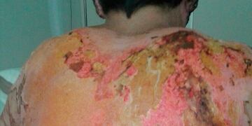 Jesús Sebastián Zárate, herido en explosión de Cofco