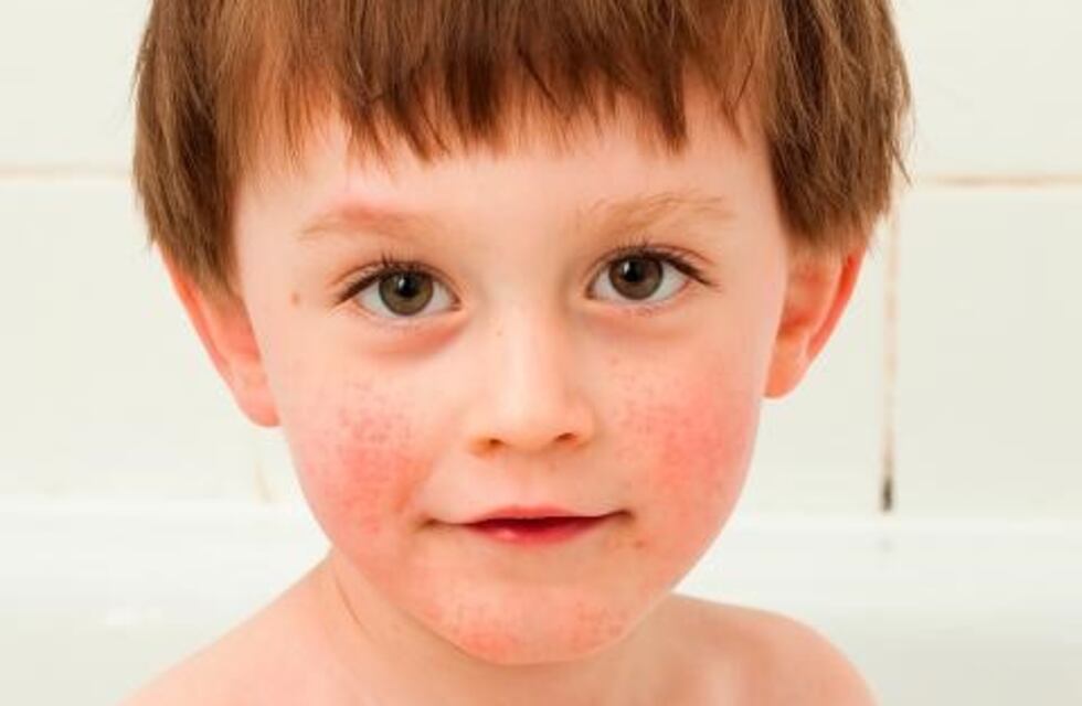 Streptococcus pyogenes: los síntomas y cómo prevenirlo