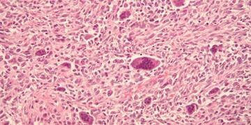 Osteosarcoma (Foto: imagen ilustrativa/web)