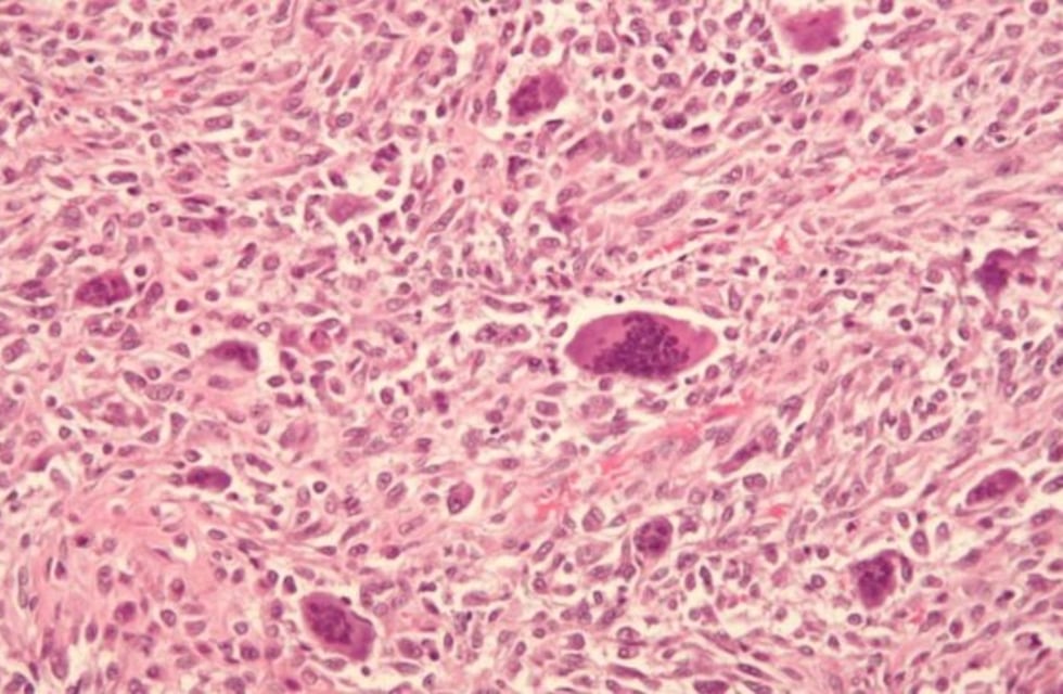 Qué es el osteosarcoma, el cáncer de huesos que padecía Xana, la hija de Luis Enrique