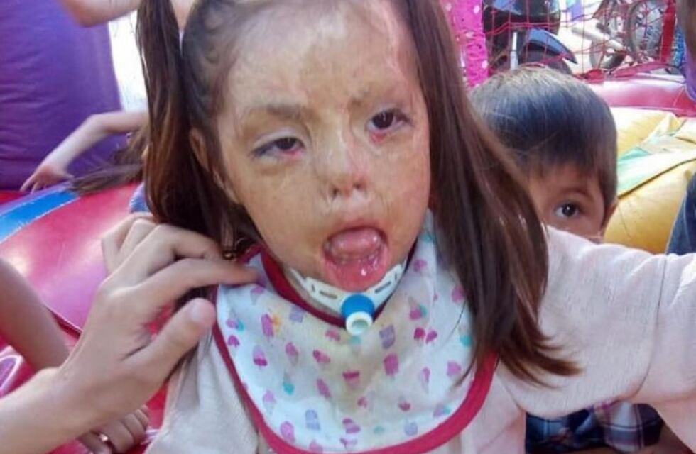Una nena de Morteros sufrió graves quemaduras y piden ayuda para operarla