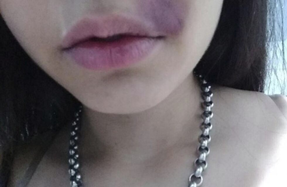 Patovicas golpearon en el rostro a una joven cuando defendía a su novio en un boliche