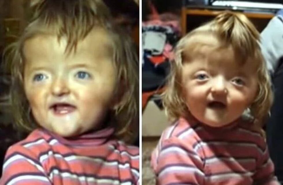 Una guardería le negó la inscripción a una nena rusa porque su cráneo deformado asustaría a otros niños