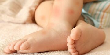 En la Semana Mundial de la Alergia dictan charla sobre alergia alimentaria\u002E