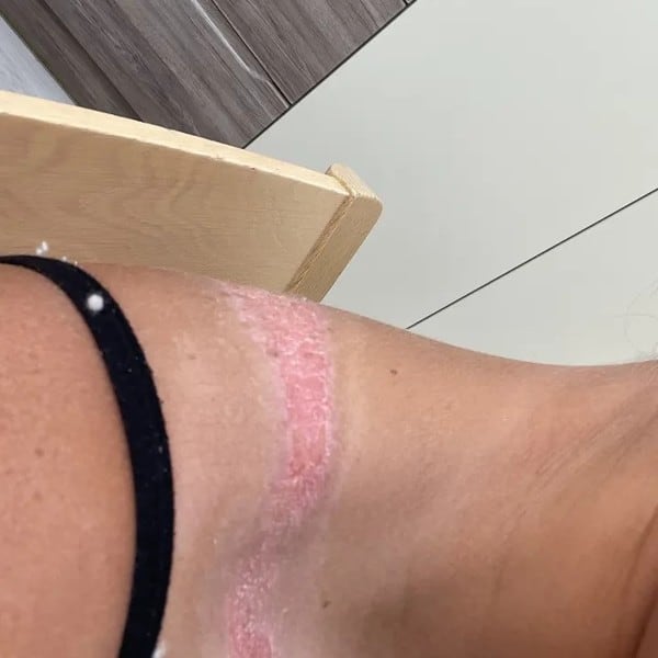 Compró un top en Shein por $7.000 y terminó con una quemadura que podría dejarle cicatriz