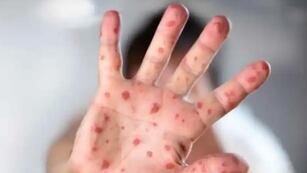 Los primeros estudios indican que es probable que el caso sospechoso en Argentina sea positivo.