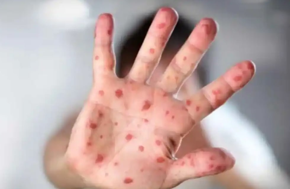 Viruela del mono: preocupan en el mundo el avance de los casos positivos