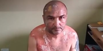 Quemado. Un hombre sufrió graves quemaduras tras ser atacado con agua hirviendo en Anisacate. (AGNoticias)