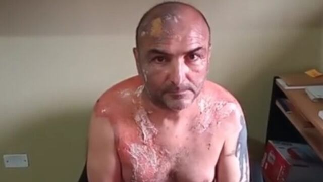 Un hombre denunció haber sufrido graves quemaduras, tras ser atacado con agua hirviendo por su exmujer (AGNoticias)
