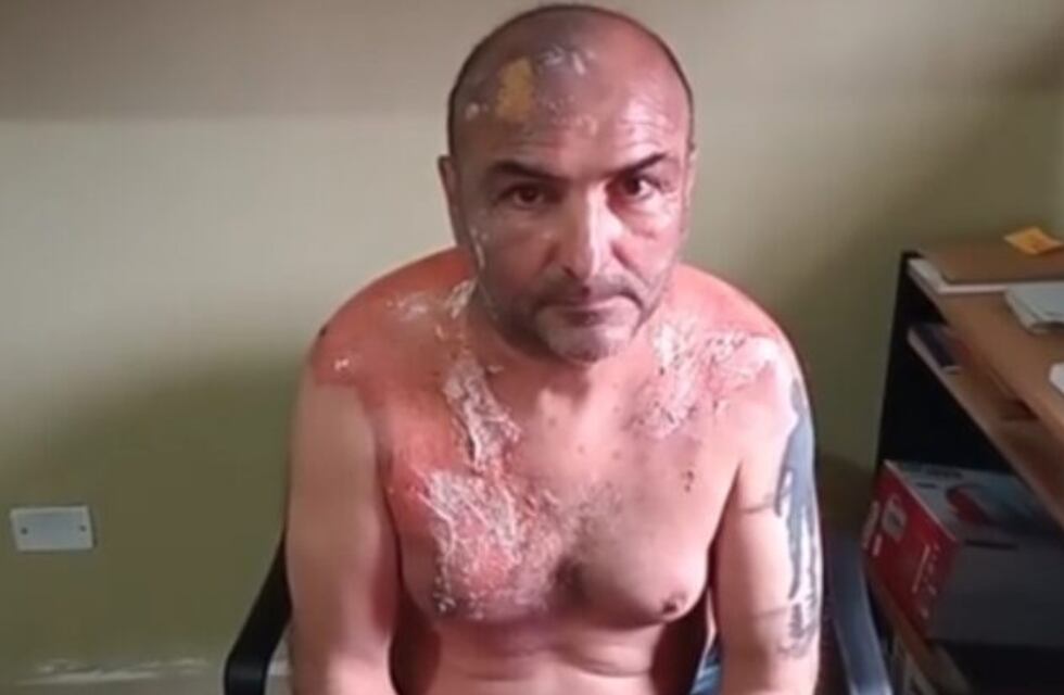 Anisacate: un hombre denunció que su exmujer le arrojó agua hirviendo