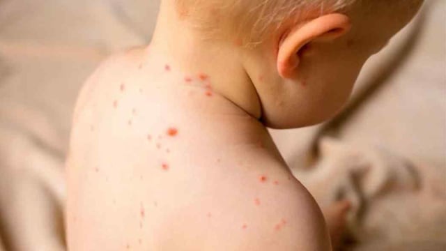Sarampión, la única prevención es la vacunación (Foto ilustrativa).