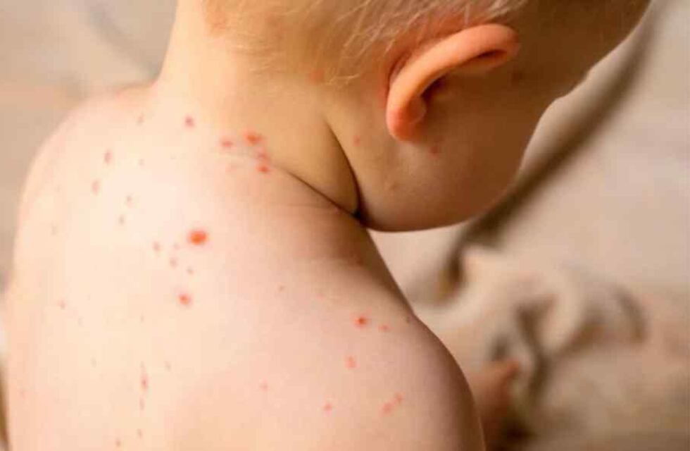 Sarampión: cuáles son los síntomas detectables y dónde vacunarse de forma gratuita