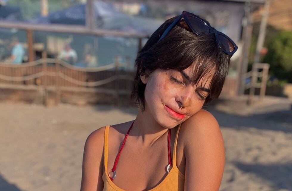 Mendocina se quemó la cara con soda cáustica, contó su historia en TikTok y se volvió viral