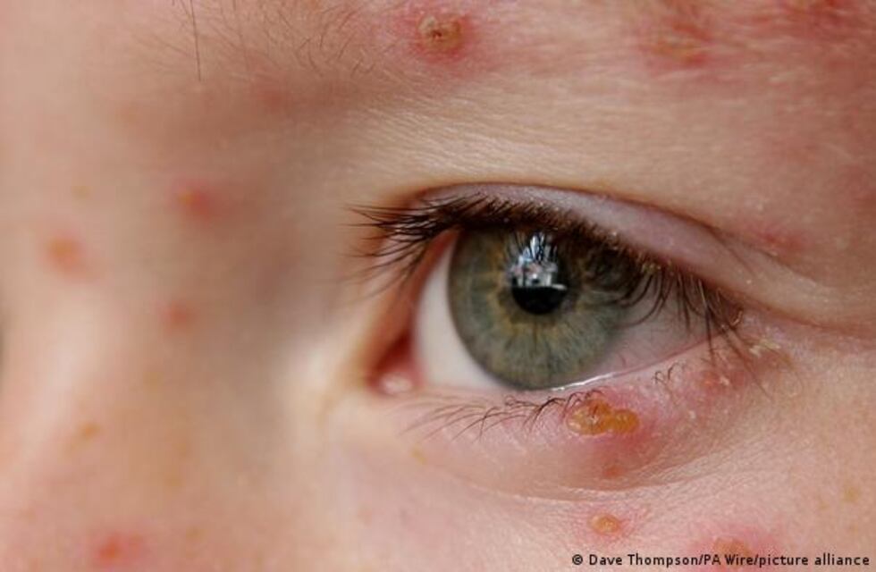 Los cuatro casos de viruela del mono en Tierra del Fuego están controlados