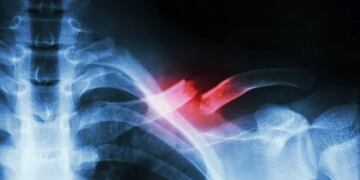 Una mujer se fracturó la clavícula luego de caer desde un techo, pero igual fue manejando hasta el hospital.