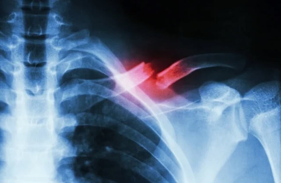 Supermujer: sacaba agua desde un techo, cayó, se fracturo y manejó ensangrentada