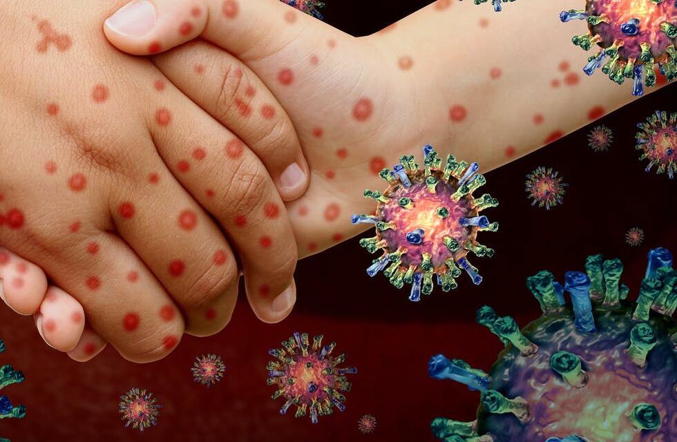 Sarampión en Entre Ríos: alerta ante la confirmación de nuevos casos en el país