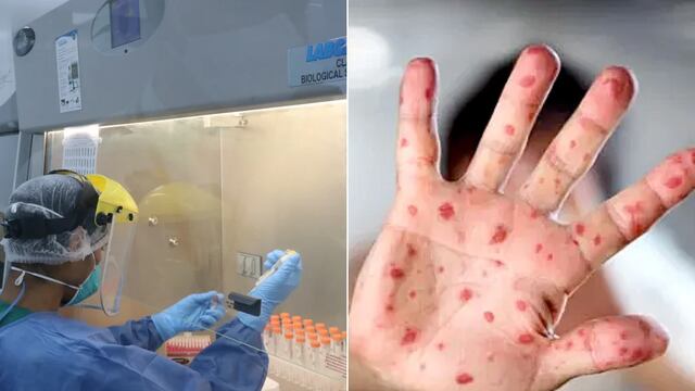 La OMS tomó la iniciativa de cambiar el nombre de la viruela del mono. Foto: Web