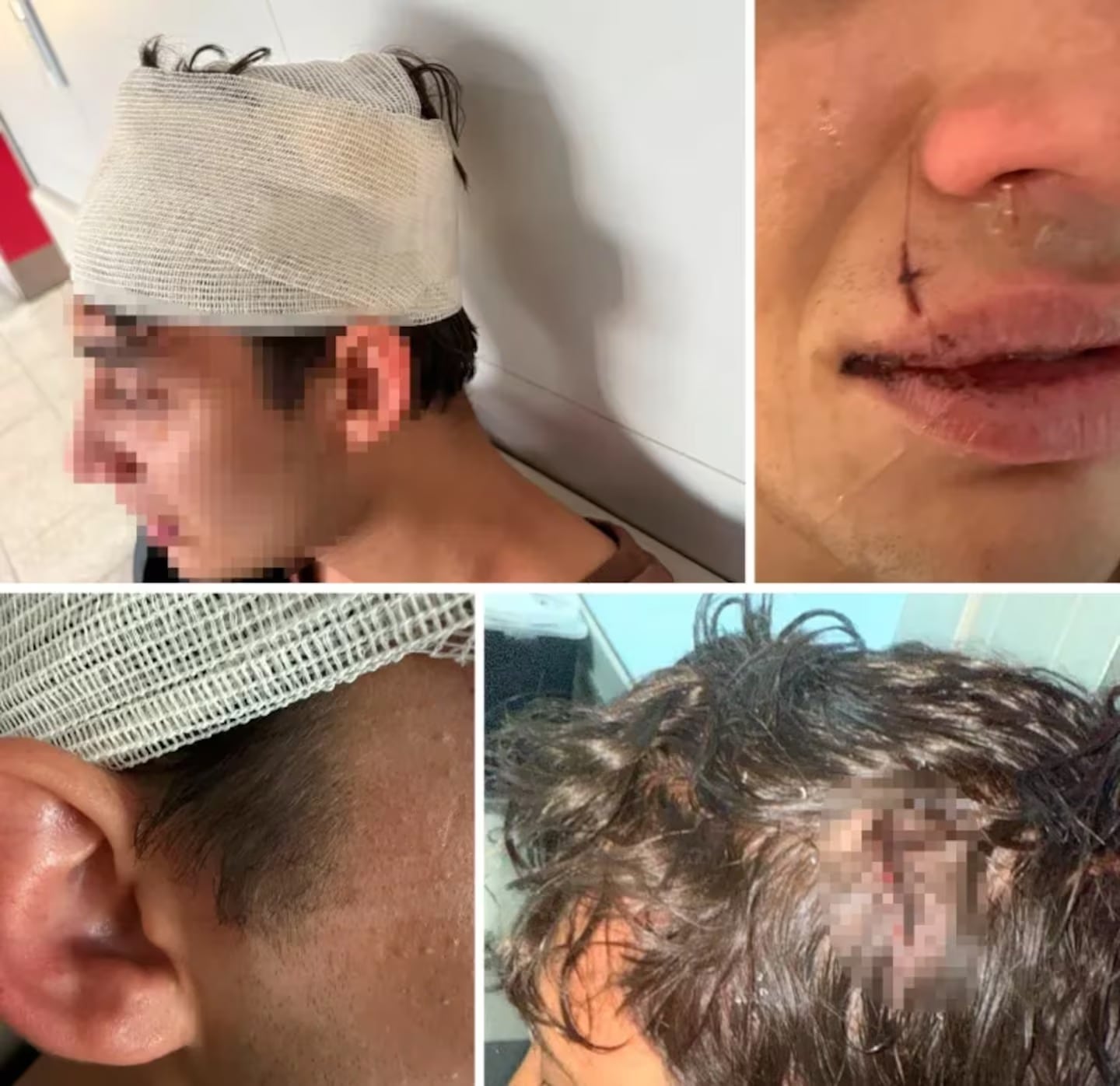 Las heridas que sufrió el joven, quien denunció una golpiza por parte de rugbiers de Córdoba en Mendoza.