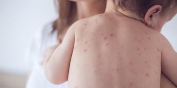 El sarampión es altamente contagioso. Los síntomas incluyen fiebre, tos, secreción nasal, ojos rojos y sarpullido. (Archivo/ La Voz).