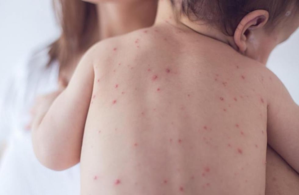 Murió un nene por una rara secuela del sarampión años después de haberlo tenido: el caso da la vuelta al mundo
