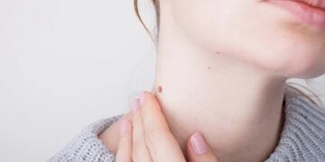 Las verrugas suelen aparecer e irse con el tiempo.