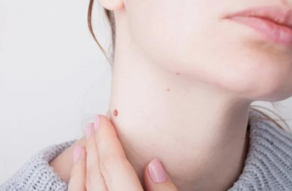 Verrugas: ¿Qué son y por qué aparecen en la piel?