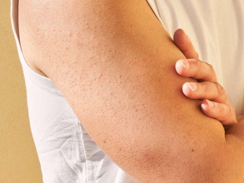 Cuáles son los síntomas de la queratosis pilaris