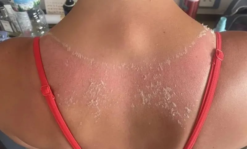Compró un top en Shein por $7.000 y terminó con una quemadura que podría dejarle cicatriz