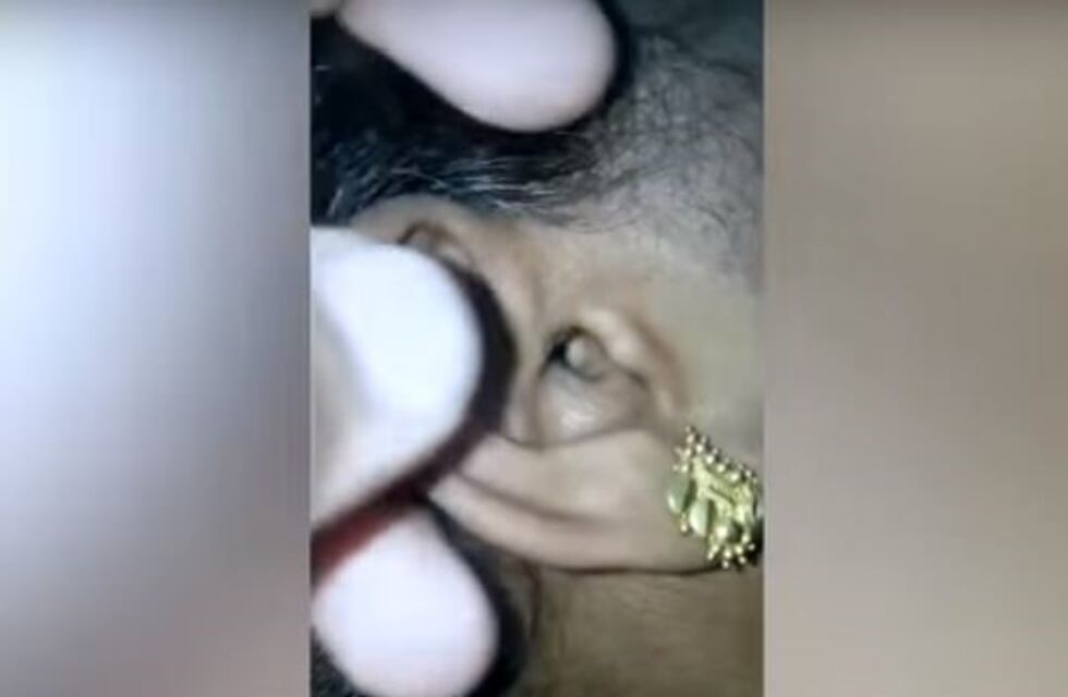 Insólito: Fue al hospital porque le dolía la cabeza y le sacaron una araña viva de la oreja