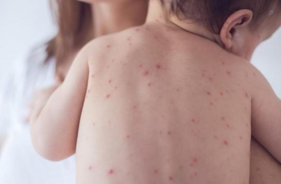 Detectan el primer caso de sarampión en Santa Fe