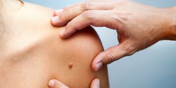 Du00eda del melanoma.