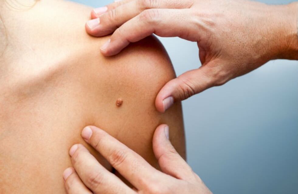 Día Mundial del Melanoma