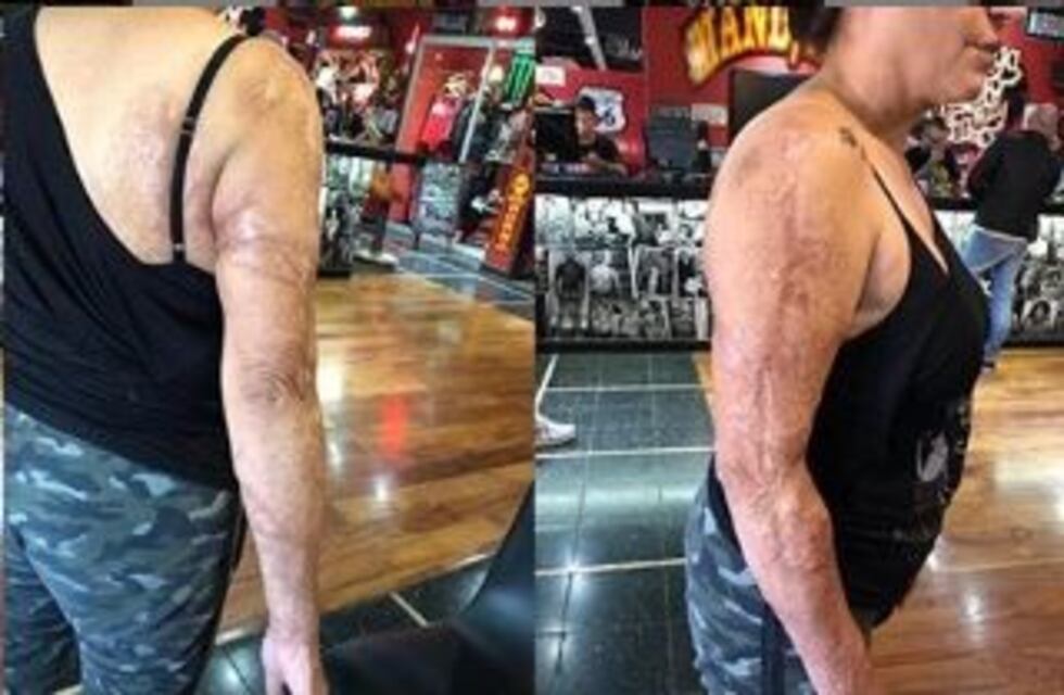 Vio a una mujer con los dos brazos quemados y le ofreció hacerle un tatuaje: el resultado es increíble