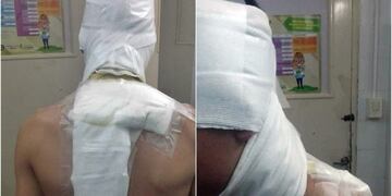 Así terminó Josué Miglia, el joven futbolista pampeano que fue agredido con agua hirviendo tras el partido entre Pico FBC y Sportivo Realicó\u002E