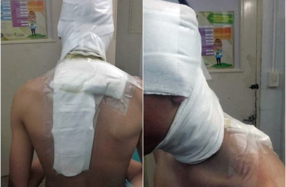 Brutal agresión en el fútbol de La Pampa: le tiraron agua hirviendo a un jugador tras el partido