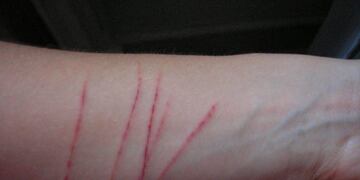 Autolesiones en adolescentes\u002E (Foto ilustrativa)