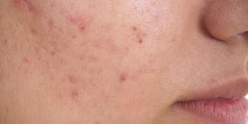 Campaña primavera sin acné